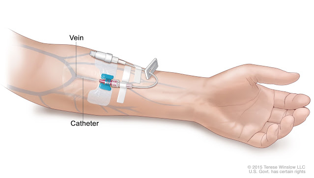 EMS Medication Administration – Intravenous (IV) Catheter Placement