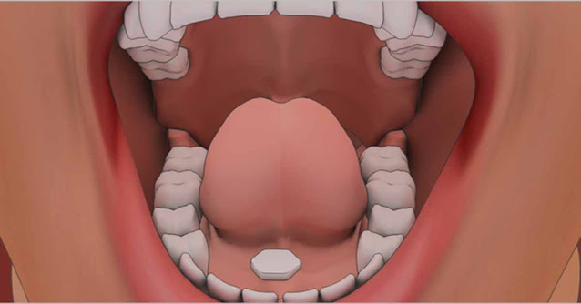 Medication Administration – Sublingual (SL) Route