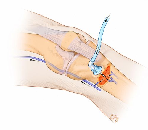 EMS Medication Administration – Intraosseous (IO) Route