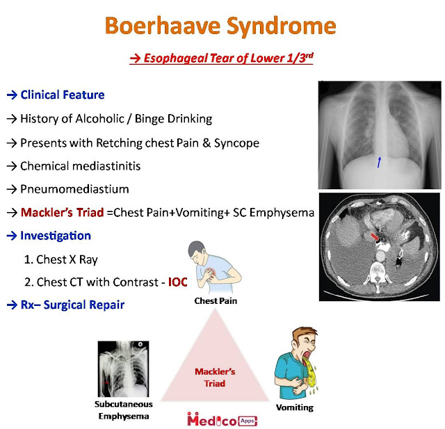 EMS Medical Terminology – Boerhaave Syndrome