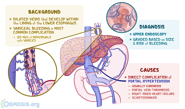 EMS Airway Emergencies – Esophageal Varices