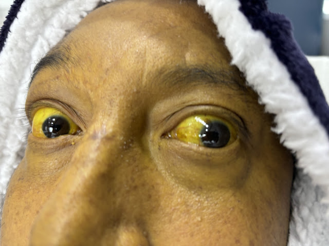 EMS Hepatic Emergencies – Scleral Icterus v Jaundice